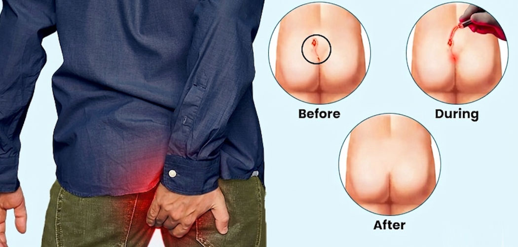 Pilonidal Sinus Surgery