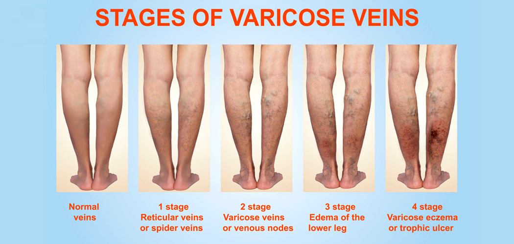 Varicose Vein Surgery