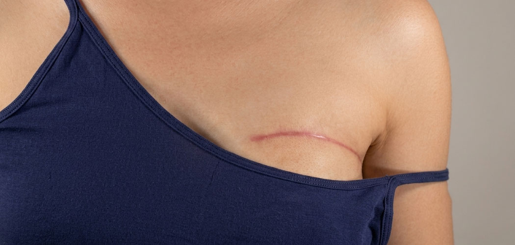 Breast Surgery